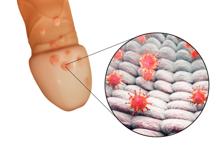 herpes genitale sul pene e virus dell'herpes a livello microscopico