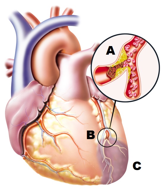 disegno anatomico del cuore con un vaso sanguigno bloccato