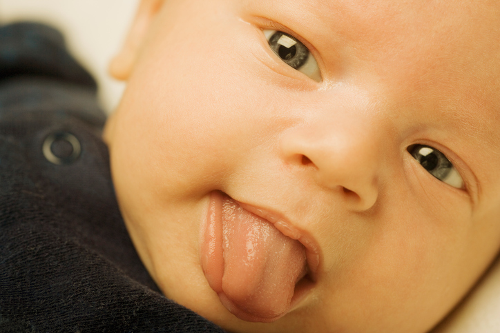 bambino con ittero che striscia la lingua