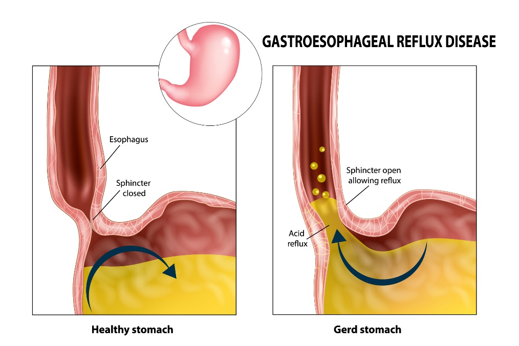 Reflusso gastroesofageo: esofago, sfintere, stomaco e succhi gastrici