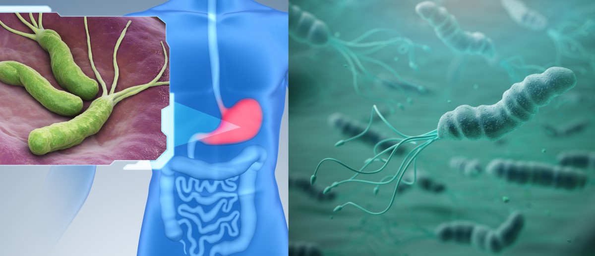 L'Helicobacter pylori colonizza il rivestimento dello stomaco ed è un fattore di rischio per gastrite, ulcera e cancro.