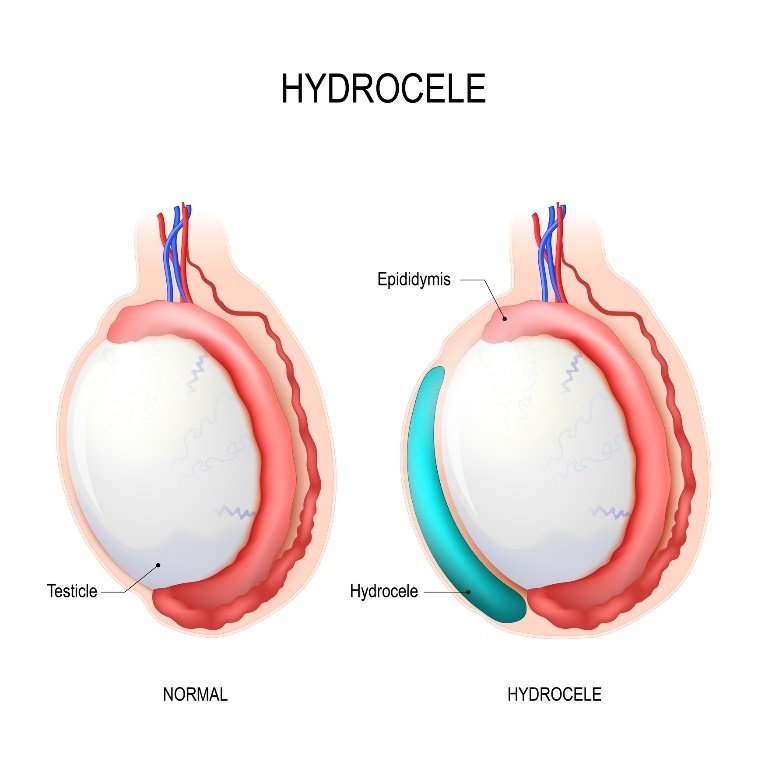 Idrocele: testicolo, epididimo, Idrocele (liquido accumulato)