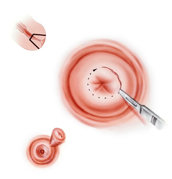 Conizzazione cervicale con bisturi