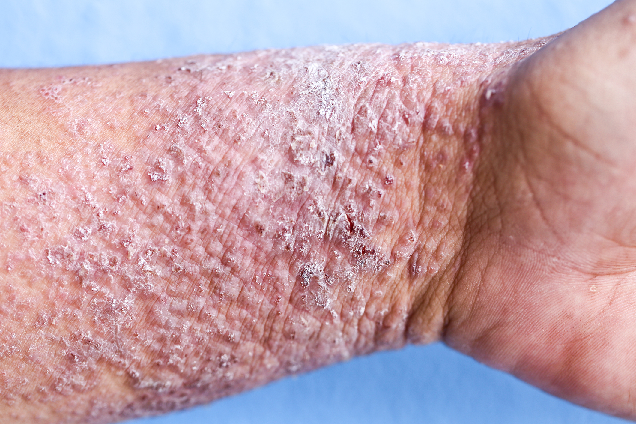 lichenificazione - ispessimento della pelle nell'eczema atopico