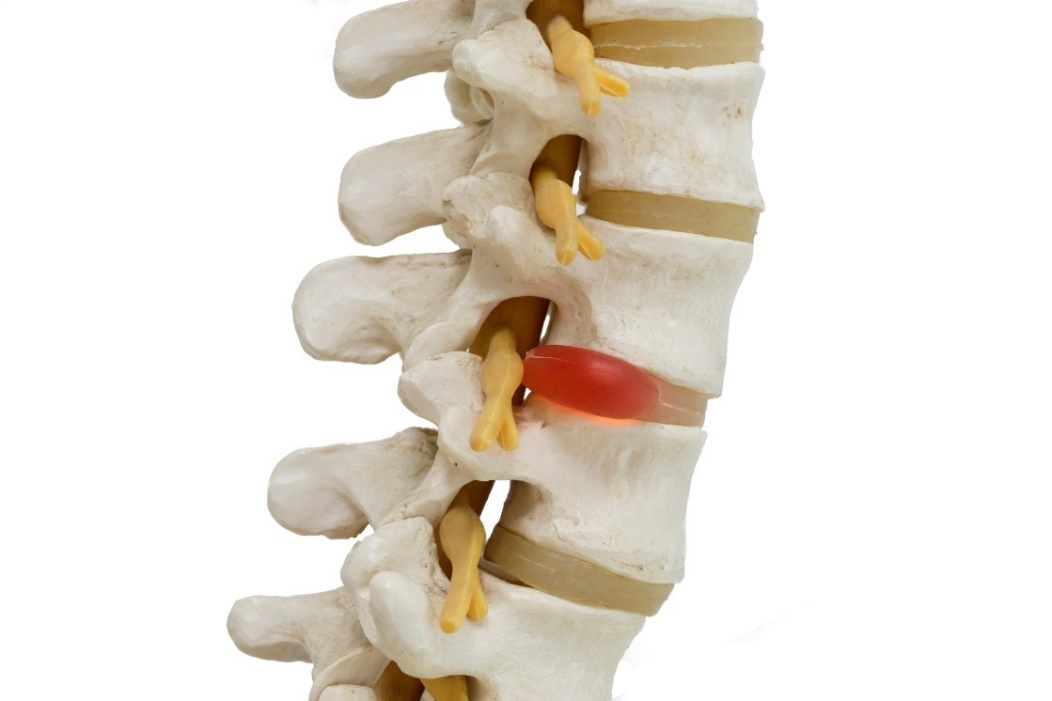 Rappresentazione anatomica di un modello 3D della colonna vertebrale, dei dischi intervertebrali e dell'ernia del disco con compressione del nervo