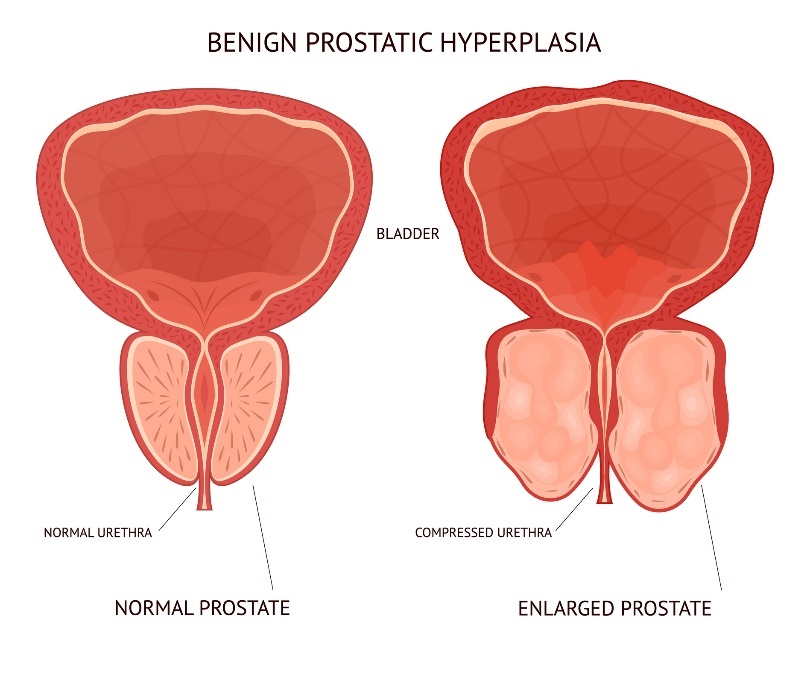 Ingrossamento benigno della prostata. Vescica (bladder), tessuto fisiologico e ingrossato dell'organo della prostata.