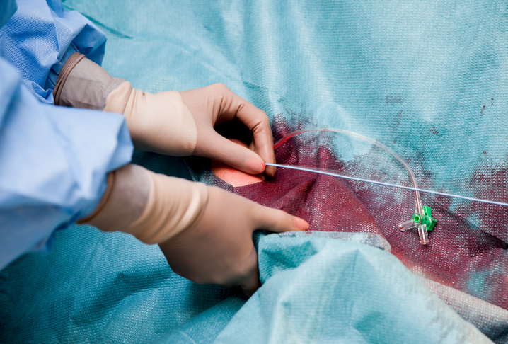 intervento al cuore, cateterismo dopo un attacco cardiaco, medico in sala operatoria