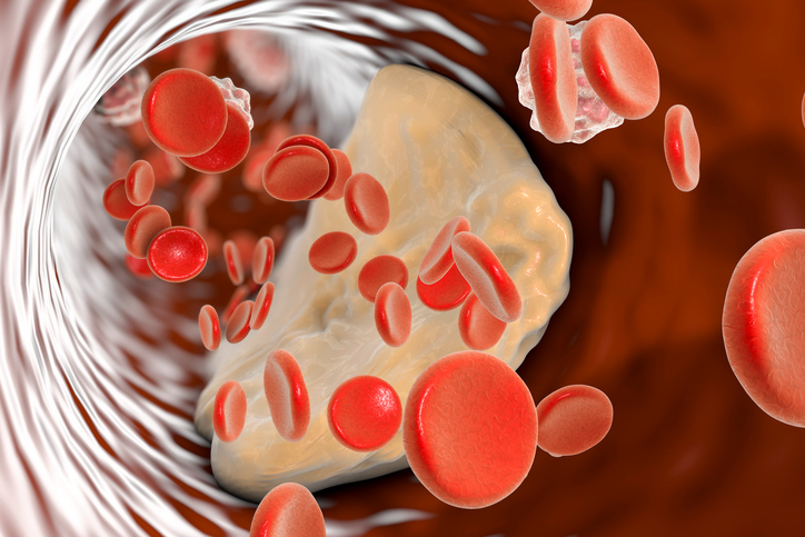 una sezione trasversale di un vaso sanguigno, con all'interno globuli rossi, particelle di grasso e placca aterosclerotica