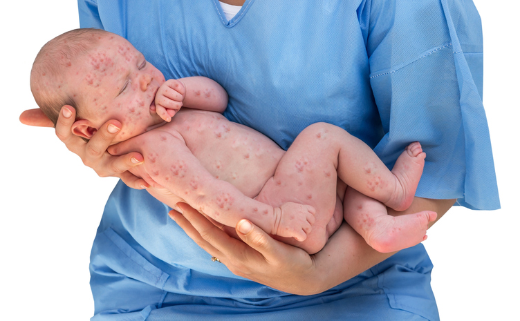 un bambino con semina cutanea sulle mani di un medico