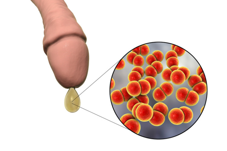 achema del pene con scarico e batteri microscopici di gonorrea