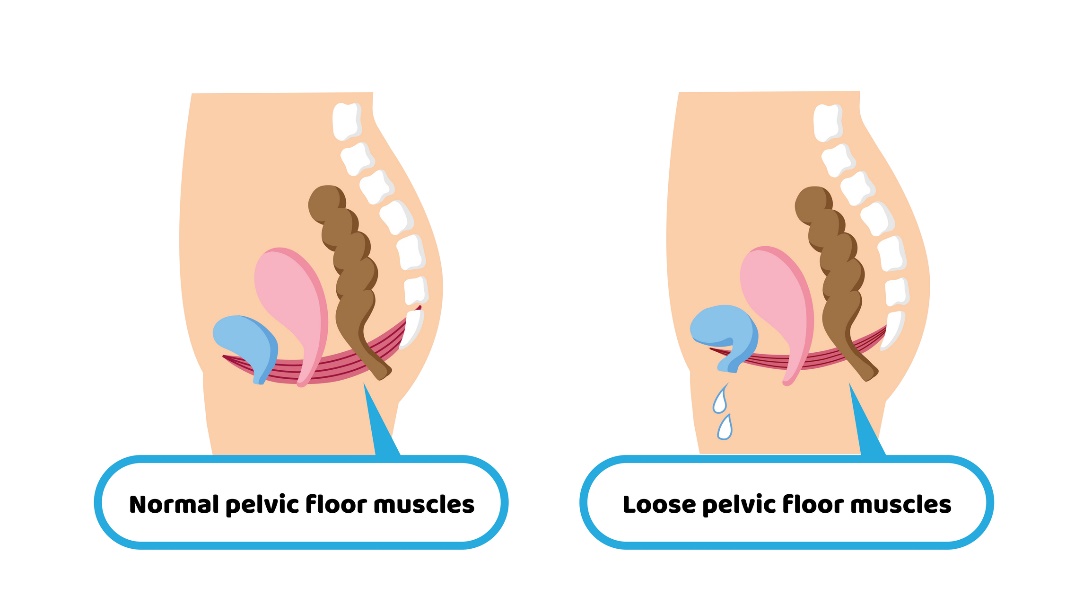 Condizione fisiologica della muscolatura del pavimento pelvico e condizione permissiva della muscolatura del pavimento pelvico con conseguente incontinenza