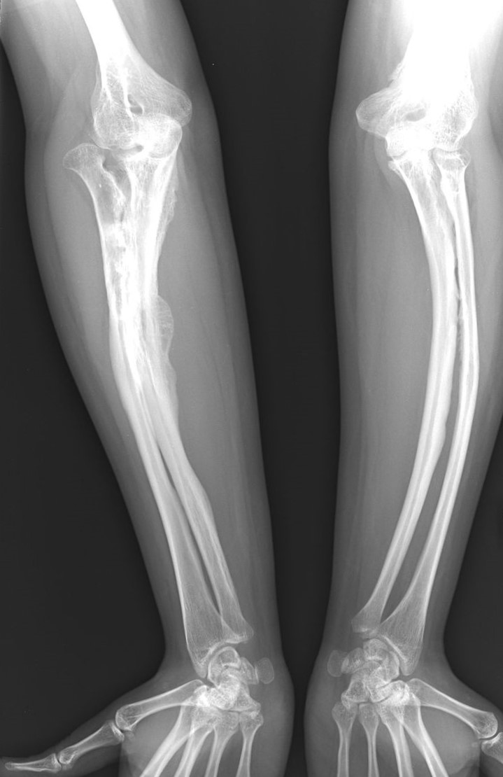 Radiografie della malattia dell'osteogenesi imperfetta in un adulto