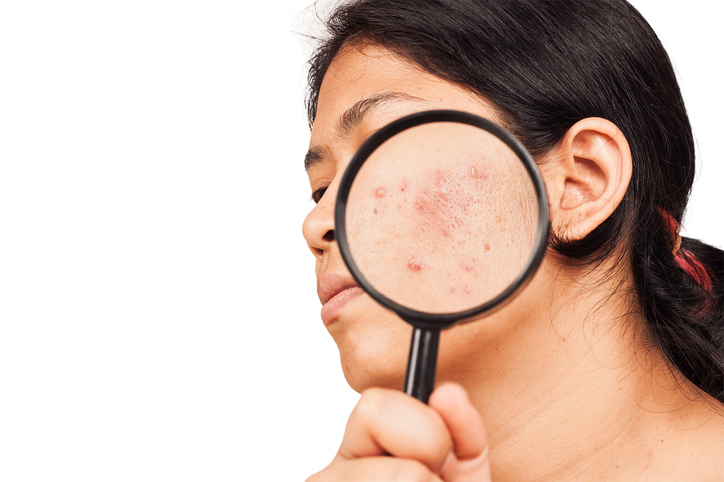 Donna con acne sul viso, ingrandimento sotto la lente d'ingrandimento