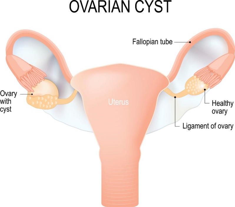 Cisti sull'ovaio