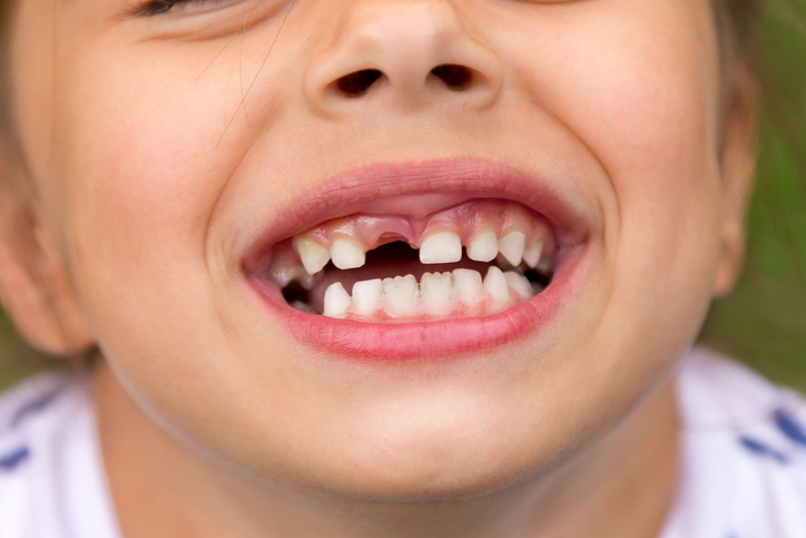 Il bambino ha un bambino, dente di bambino, primo dente caduto, sorriso