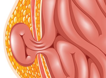 L'ernia, la complicazione più comune dell'ascite