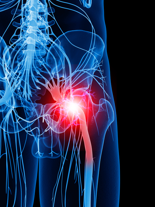 Modello del nervo dei glutei, cioè il nervo sciatico, e dolore nella zona, cioè sciatica, irradiazione del dolore all'arto inferiore