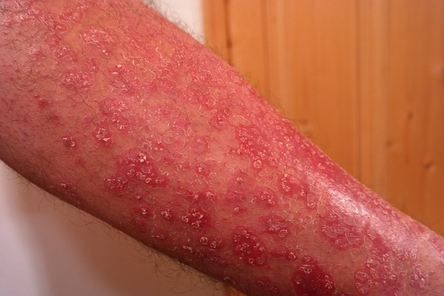 Psoriasi sugli avambracci, pelle squamosa e arrossata, con perdita di capelli