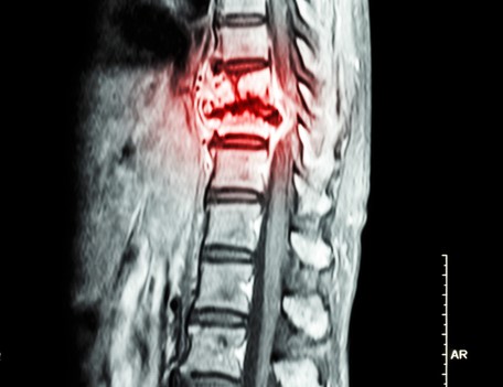 Radiografia della colonna vertebrale toracica con evidenza di tumore nella colonna vertebrale toracica