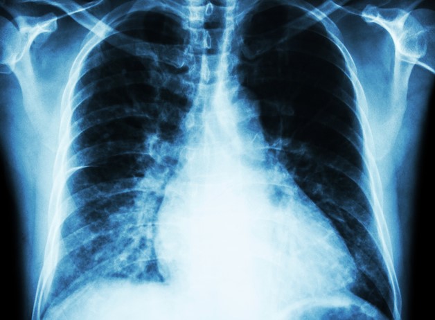 Radiografia del torace, cuore - ingrandimento