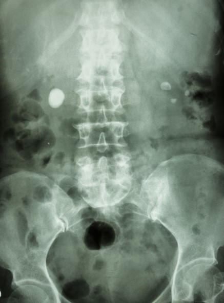 Radiografia dell'addome, calcoli renali su entrambi i lati, in entrambi i reni