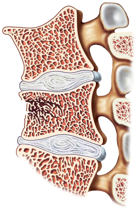 colonna vertebrale, rappresentazione delle vertebre e dei dischi intervertebrali, frattura vertebrale