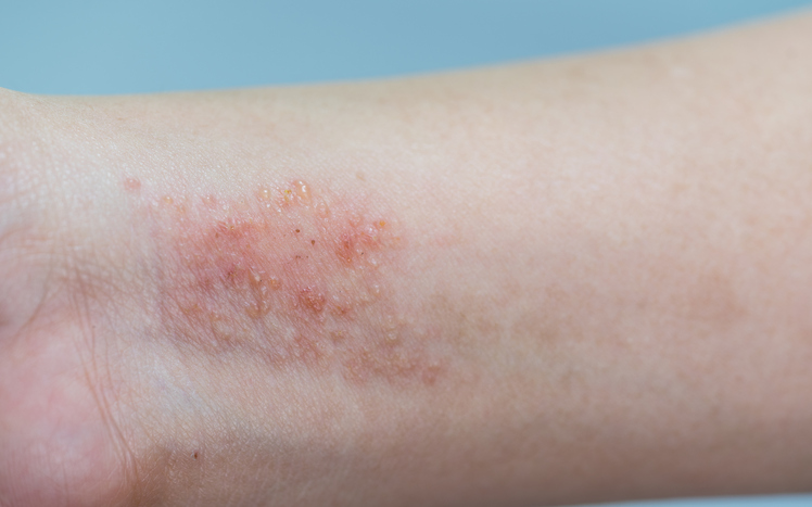 Eczema sui polsi e sugli avambracci, infiammazione della pelle gonfia e arrossata come la dermatite da contatto