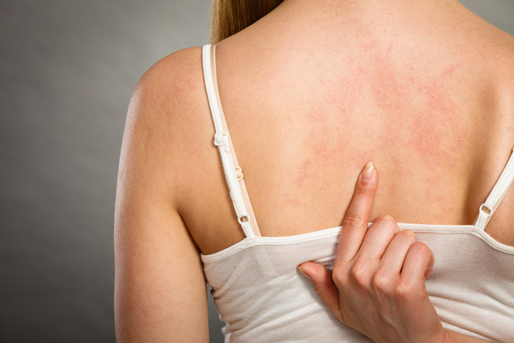 La donna ha l'orticaria sulla schiena, quindi punta il dito contro di essa.