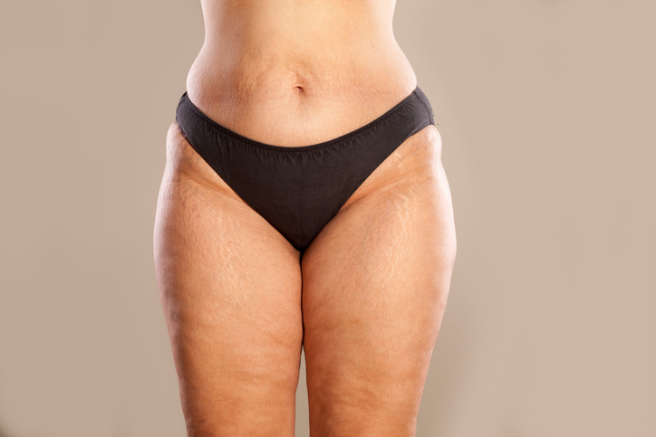 Cellulite, cosce, donna