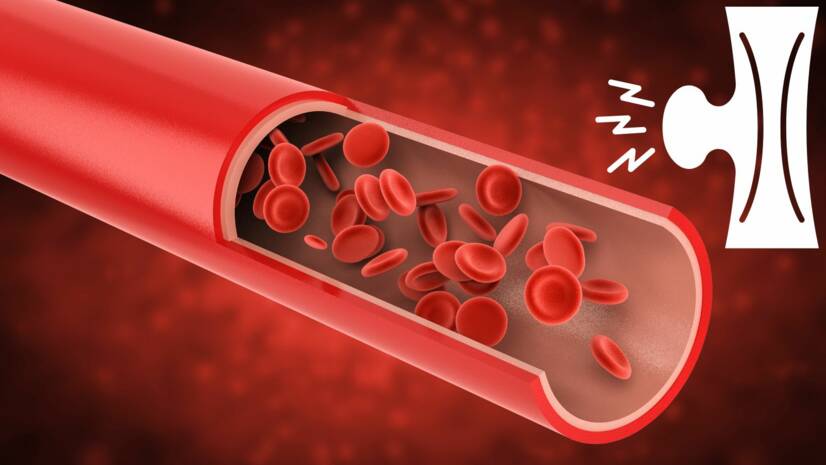 Aneurisma: cos'è un aneurisma vascolare, come si manifesta e quali sono i suoi rischi?