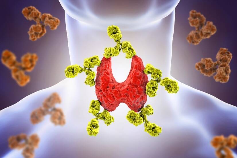 Tiroidite autoimmune: malattia di Hashimoto, cause e sintomi