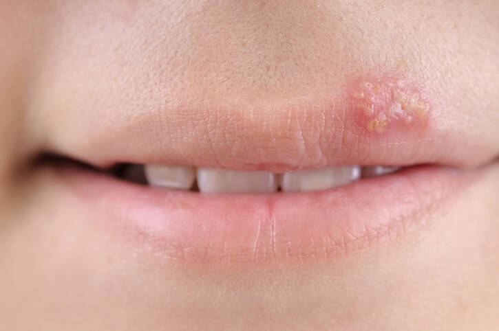 Herpes labiale: perché l'herpes si manifesta e cosa può aiutare nel trattamento (cosa fare per l'herpes labiale)?