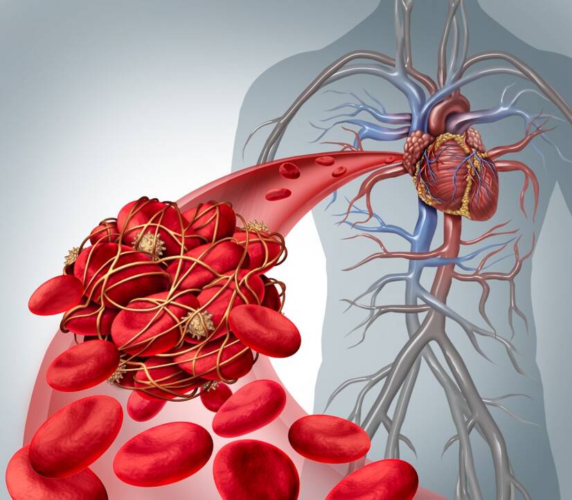 La malattia tromboembolica, perché si verifica e come è correlata all'embolia polmonare?