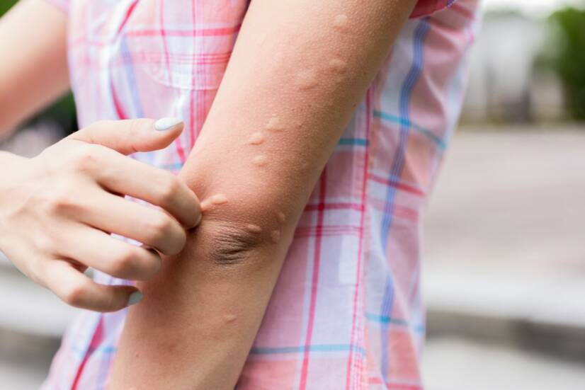 Orticaria: l'orticaria non si manifesta solo dopo una bruciatura da ortica, ma è sinonimo di malattia?