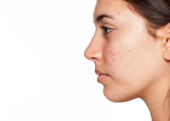 Acne: quali forme di acne conosciamo? Come trattare la pelle a casa?