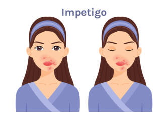 Cos'è l'impetigine, quali sintomi presenta? Infettività e trasmissione nei bambini