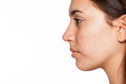 Acne: quali forme di acne conosciamo? Come trattare la pelle a casa?