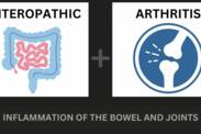 Artrite enteropatica e malattia infiammatoria intestinale: come sono correlate + Sintomi